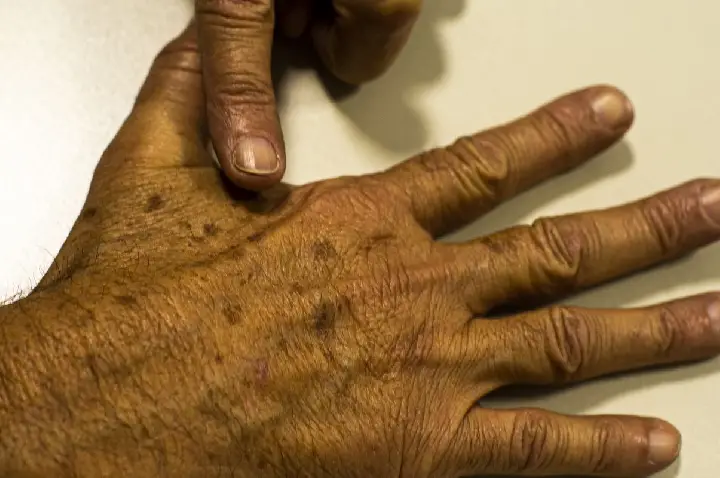 Desinformação sobre câncer de pele afeta diagnóstico, diz instituição