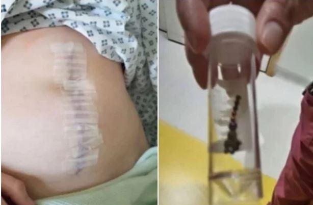 Jovem perde parte do intestino após “desafio do piercing” no TikTok