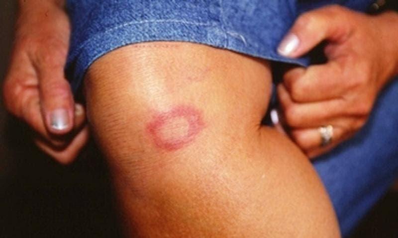 Mais de 2 mil novos casos de hanseníase são registrados no RN em uma década