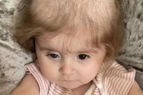 Menina de 2 anos com doença rara arranca o próprio cabelo para comer