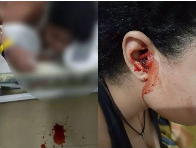 Jovem com sangramentos pelo nariz, boca e ouvidos passa por cirurgia e retira 'glândulas adenoides'; entenda