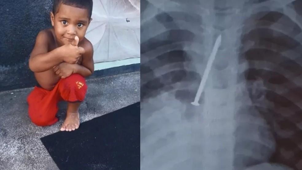 Menino morre após passar 1 ano com prego no pulmão; família acusa hospital de negligência