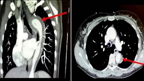 Mulher sofre vazamento na aorta durante orgasmo, em caso médico incomum