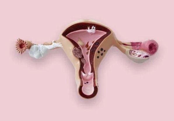 Endometriose: conheça outros sintomas além da cólica menstrual intensa