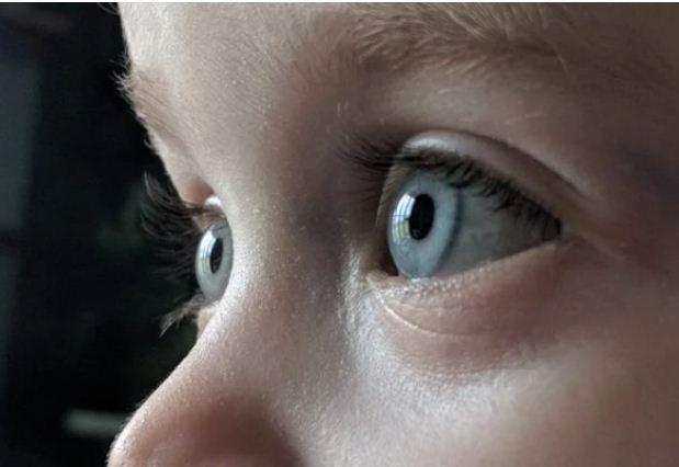 Retinoblastoma: entenda como detectar câncer comum em crianças