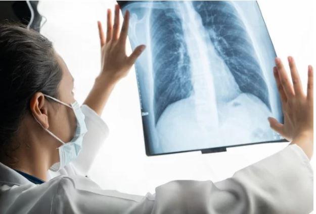 OMS alerta para alta de casos subnotificados de tuberculose no mundo