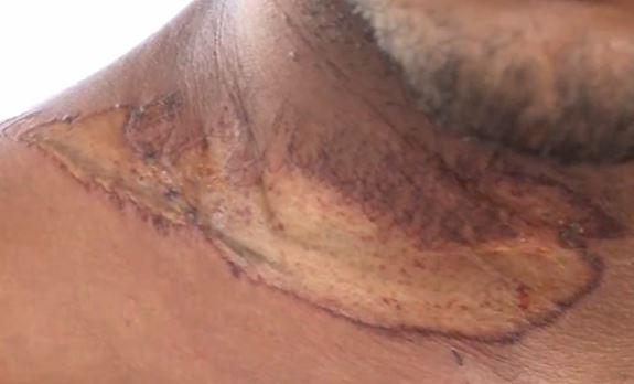 Motociclista quase morre ao ficar com pescoço enrolado por fio na Grande Natal