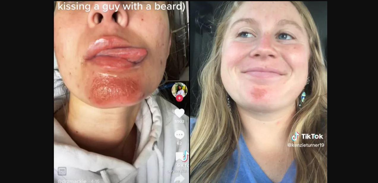 Beijar alguém com fungos na barba causa lesões? Dermatologistas explicam