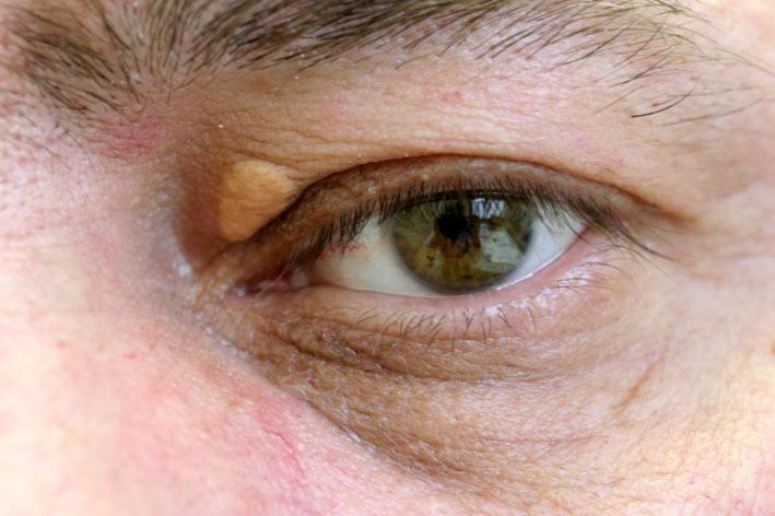 Colesterol perigosamente alto vê-se nos olhos. Fique atento a este sinal