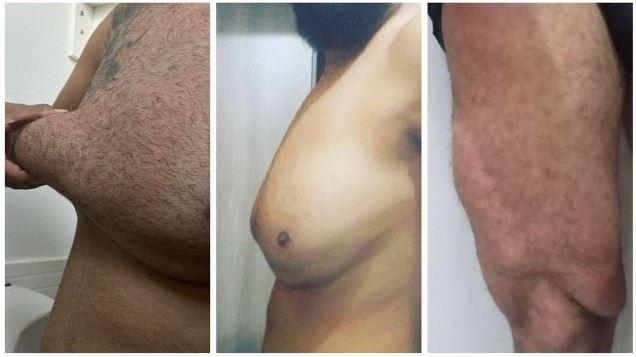 Homem sofre com deformações após injetar gel em casa: 'Queria ganhar físico rápido'