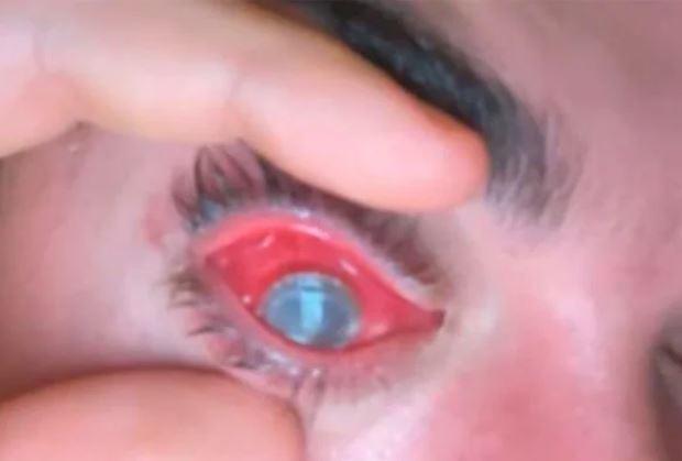 Jovem fica cego de um olho após dormir com lente de contato