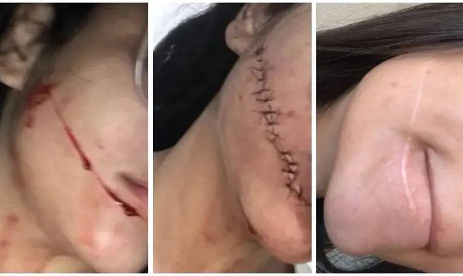 ‘Não conseguia me olhar no espelho’, diz jovem que teve rosto cortado