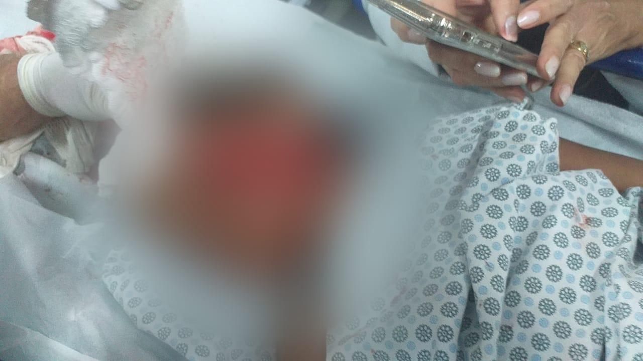 Criança de 5 anos é atacada por pitbull na Grande Natal