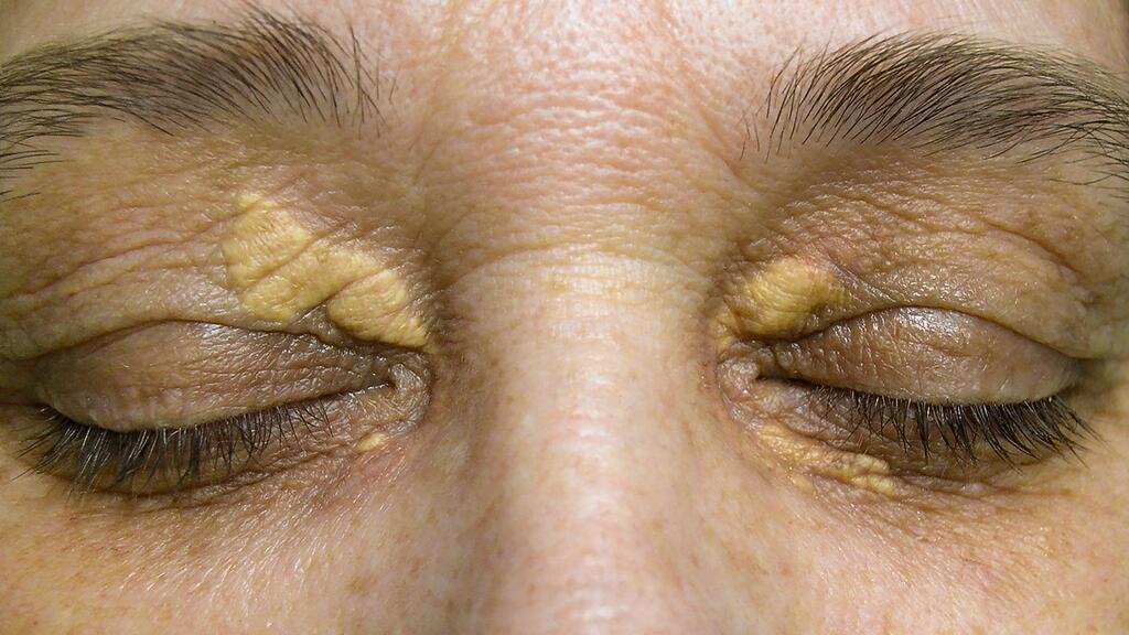 4 sintomas de triglicerídeos altos no seu corpo que você deve dar atenção e o que fazer