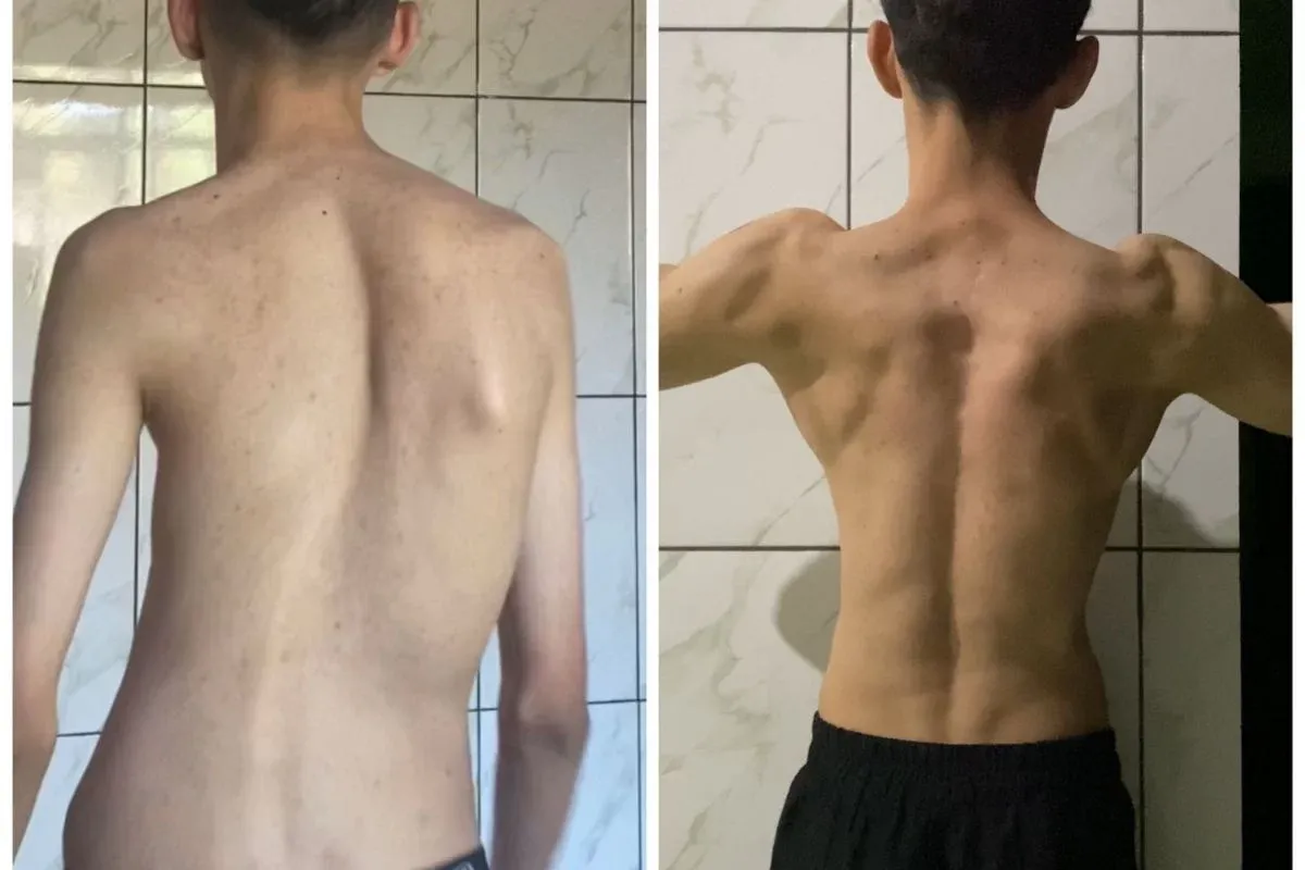 Conheça jovem que viralizou nas redes ao se curar de escoliose severa