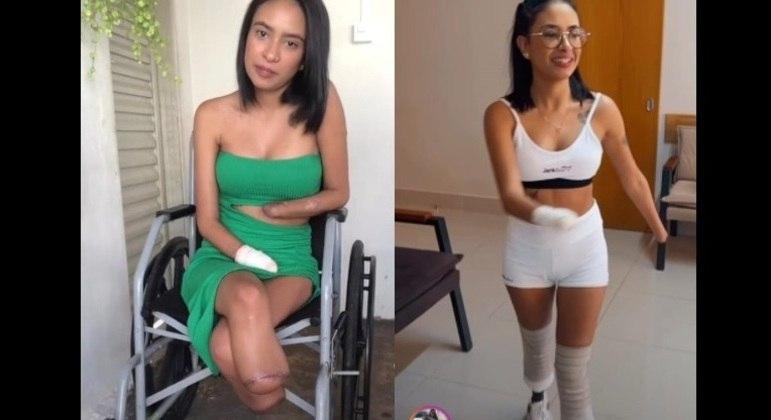Jovem que teve mãos e pés amputados após infecção urinária sai de clínica usando próteses