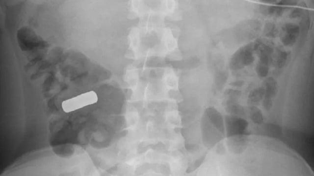 Adolescente dá entrada em hospital com fortes cólicas e causa assusta médicos